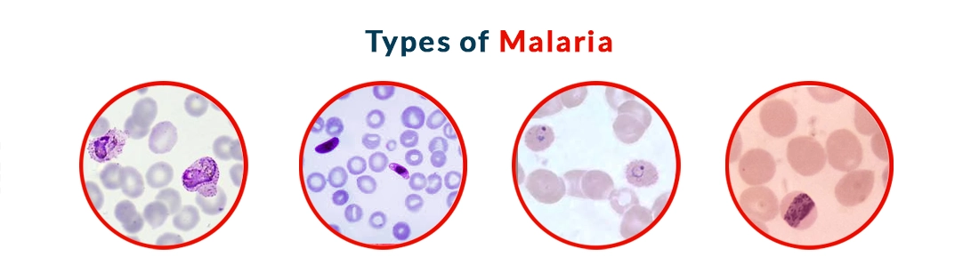 Types of Malaria